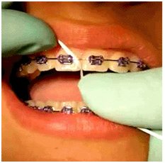 Ortodonti Hastaları Bakım